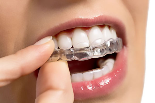 clear aligners Killeen, TX