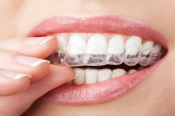 How Long Do I Have To Wear Clear Aligners?