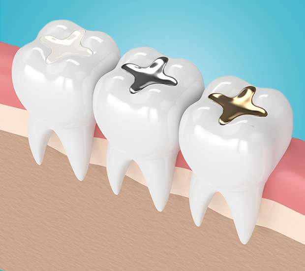 Killeen Composite Fillings