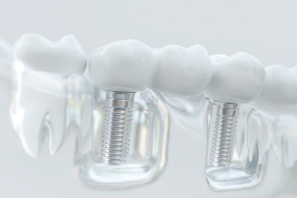 Dental Implant Prosthesis Options For Replacing Missing Teeth