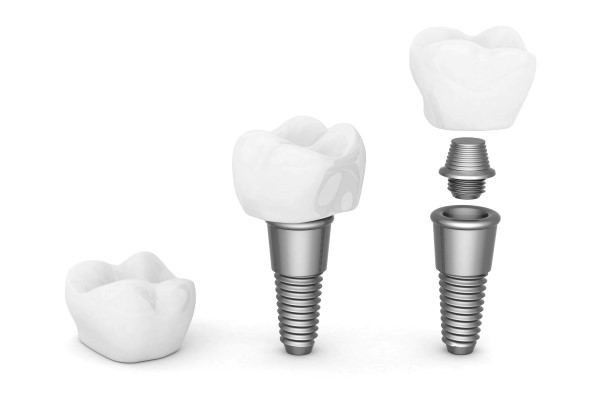 How A Dental Implant Restoration Can Improve Your Oral Health
