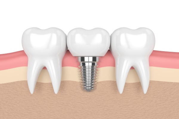 Replace Missing Teeth With Dental Implants