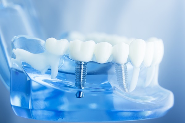 Smile Again With Dental Implants