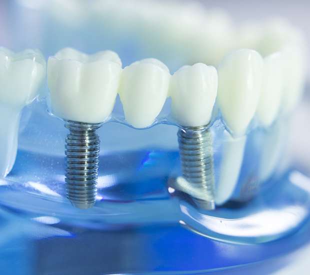 Killeen Dental Implants