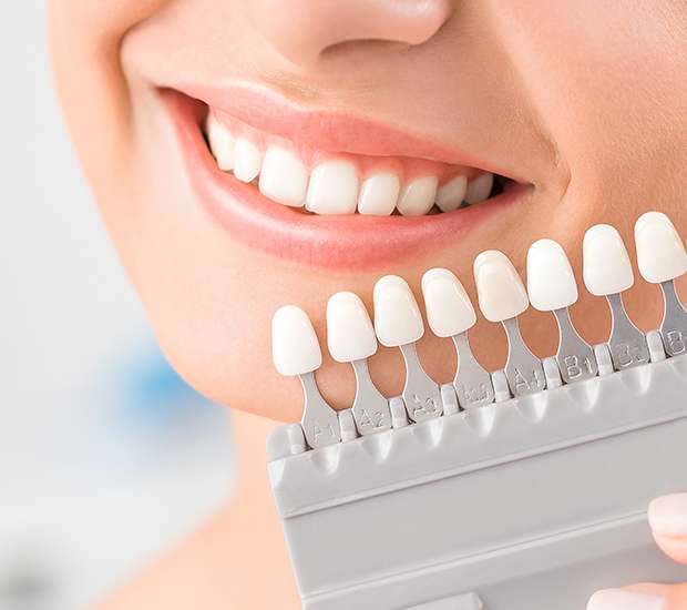 Killeen Dental Veneers and Dental Laminates