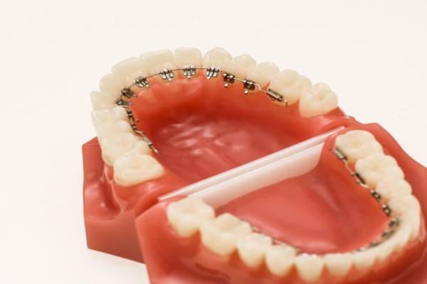 What To Know About Teeth Straightening With Fastbraces