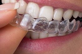 Invisalign