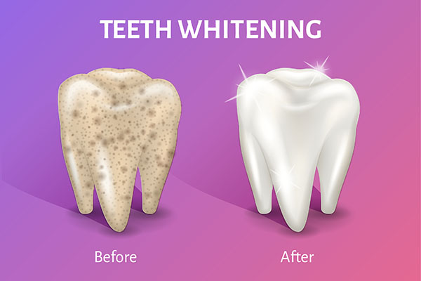 Side Effects Of Teeth Whitening Treatments