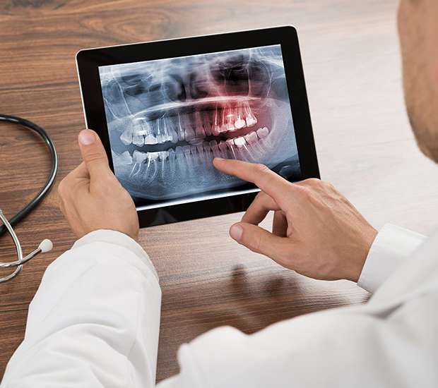 Killeen Types of Dental Root Fractures